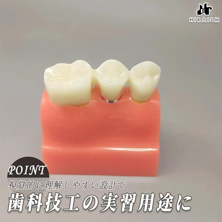 歯科模型 可動式 HIRAISM 歯科模型 インプラント説明用モデル 可動式 義歯 着脱式 教材