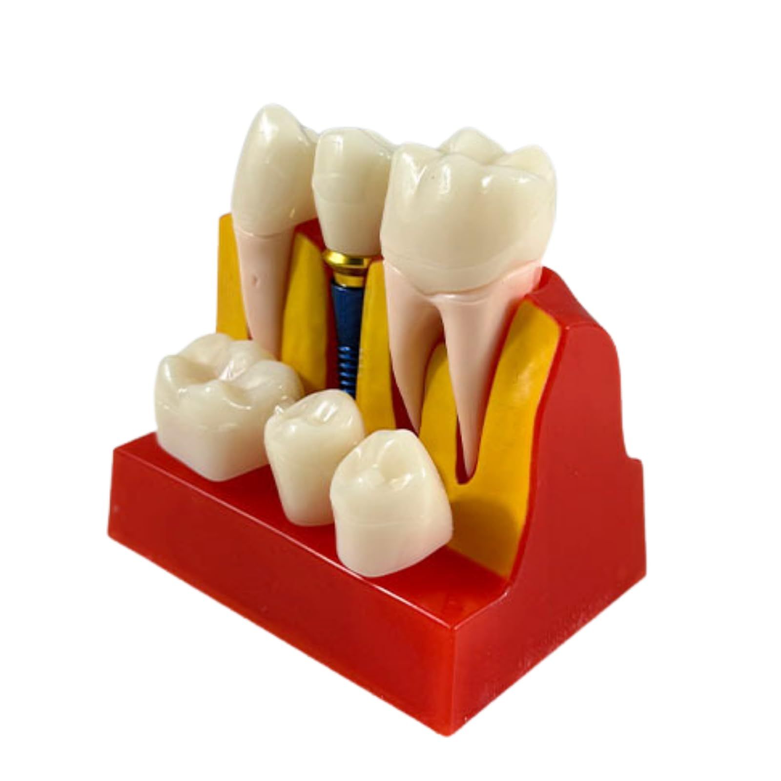 ideamall インプラント 模型 歯 講習 練習 モデル 教育 コンパクト