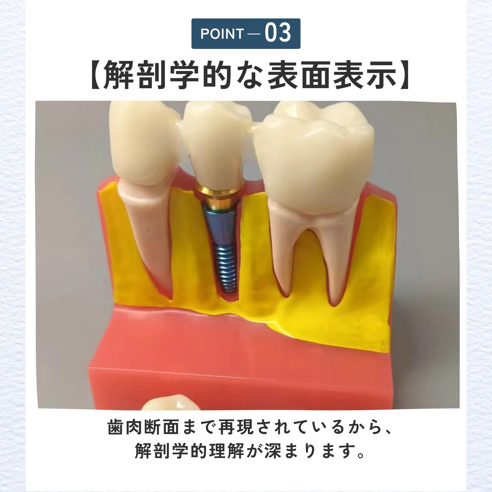 ideamall インプラント 模型 歯 講習 練習 モデル 教育 コンパクト