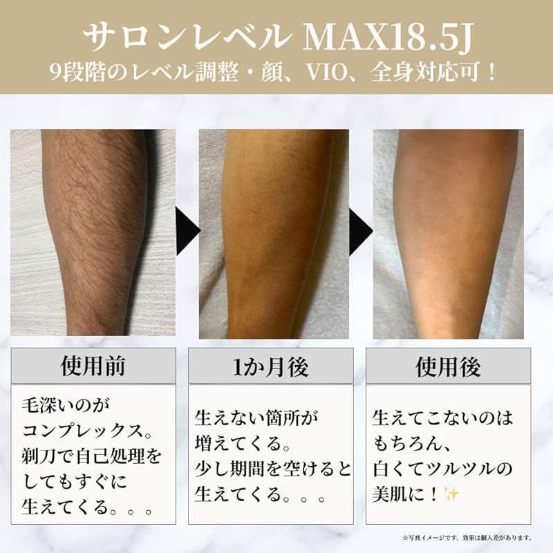 脱毛機 VIO対応