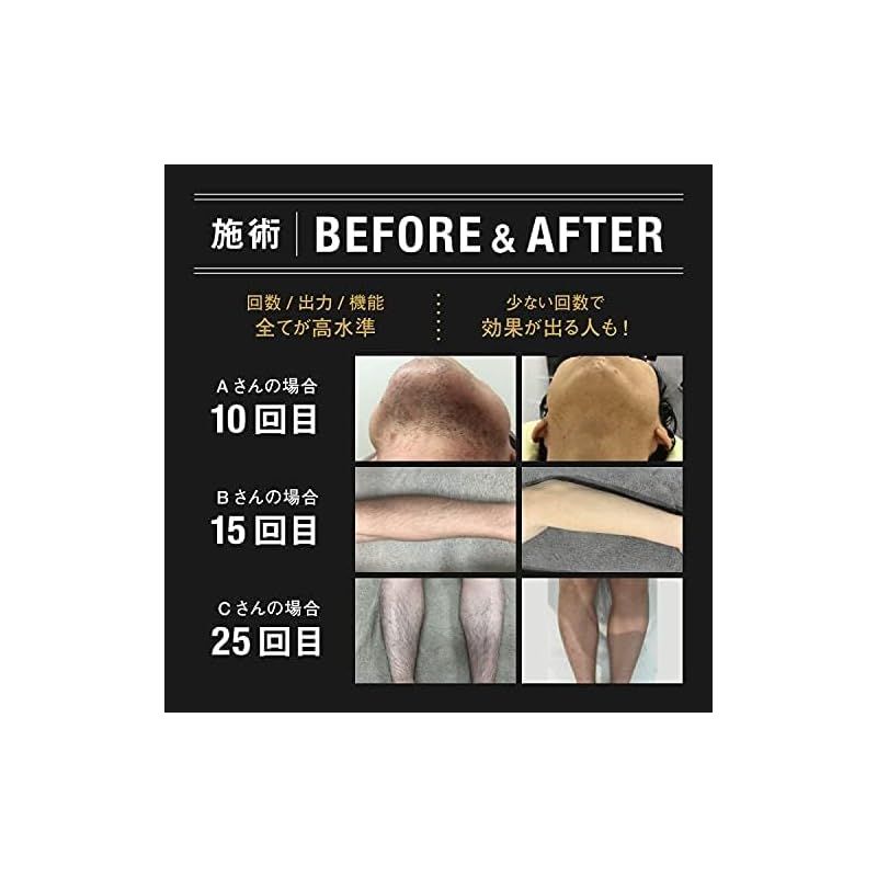 即納：MCLEAR メンズクリア ホームクリア MAX 脱毛器 メンズ 限定特典