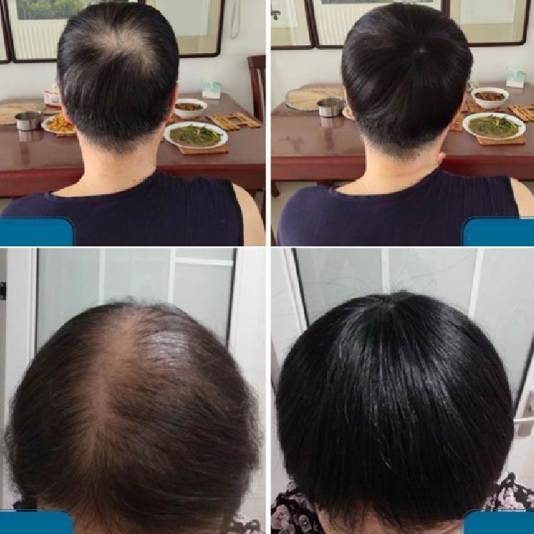 ヘアピース 人毛100% トップピース つむじ 部分ウィッグ トップカバー