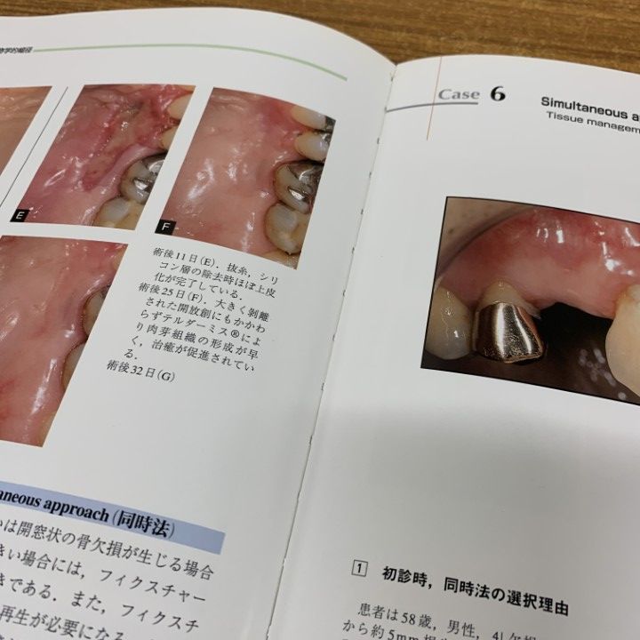 △01)【1点限り!】インプラント周囲のティッシュ・マネージメント/佐藤