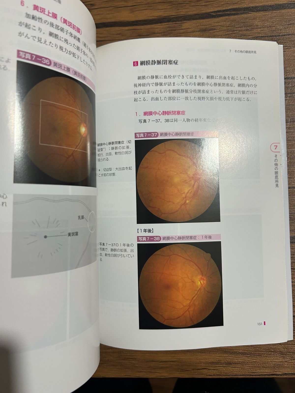 健診のための眼底検査 改訂版〜無散瞳カメラによる撮影