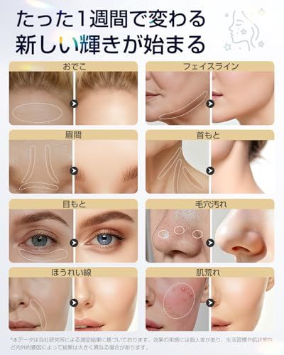 美顔器 高周波 RF EMS MC 1台18役 温冷 【2026業界初・ラジオ波