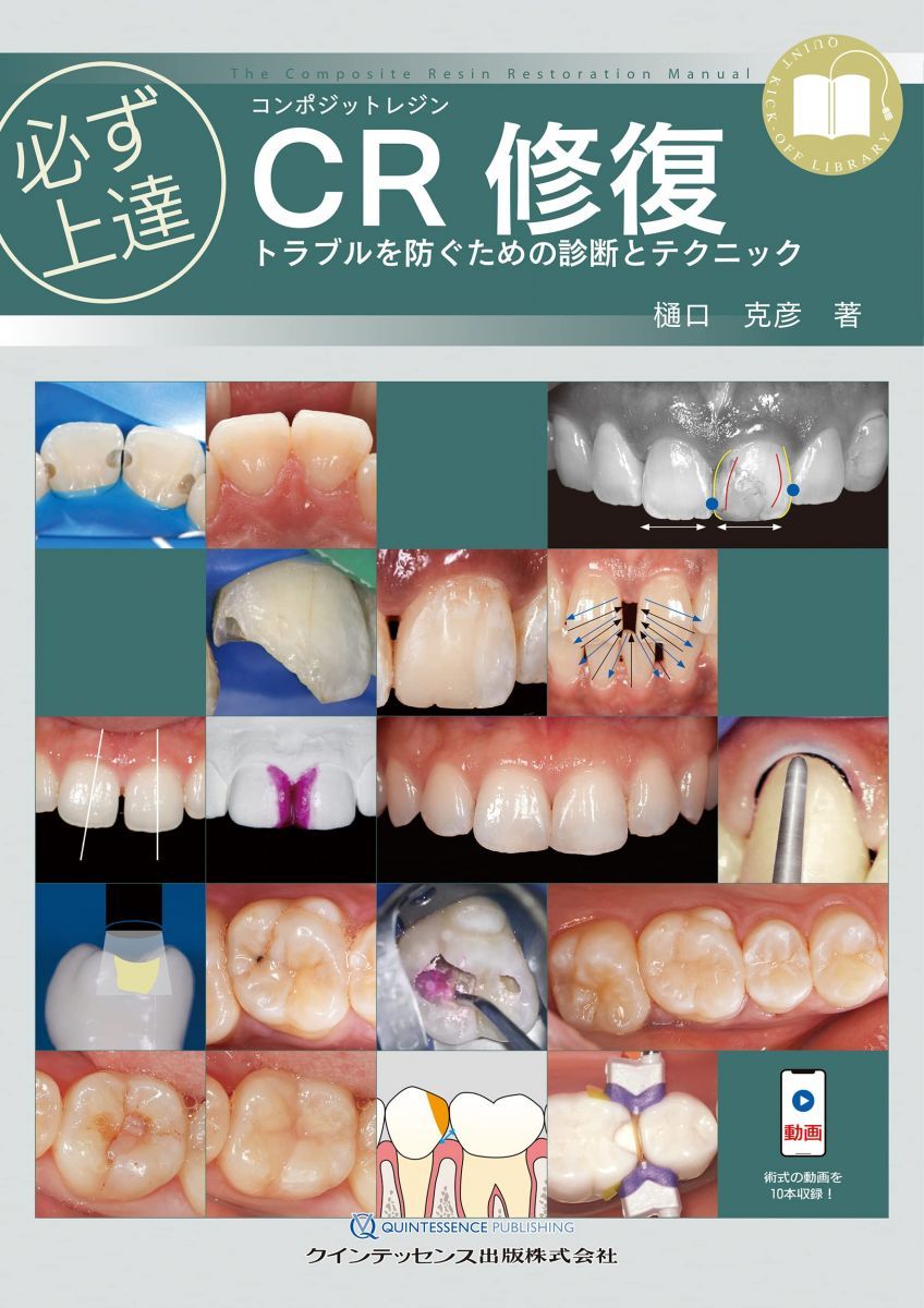 必ず上達 CR(コンポジットレジン)修復: トラブルを防ぐための診断とテクニック