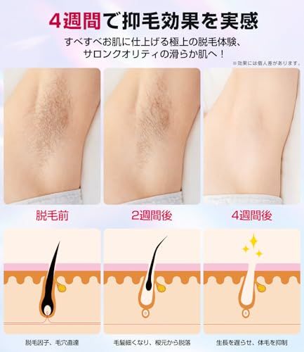 脱毛器 VIO対応【サロン級IPL光脱毛器】メンズ 髭 レディース 高出力