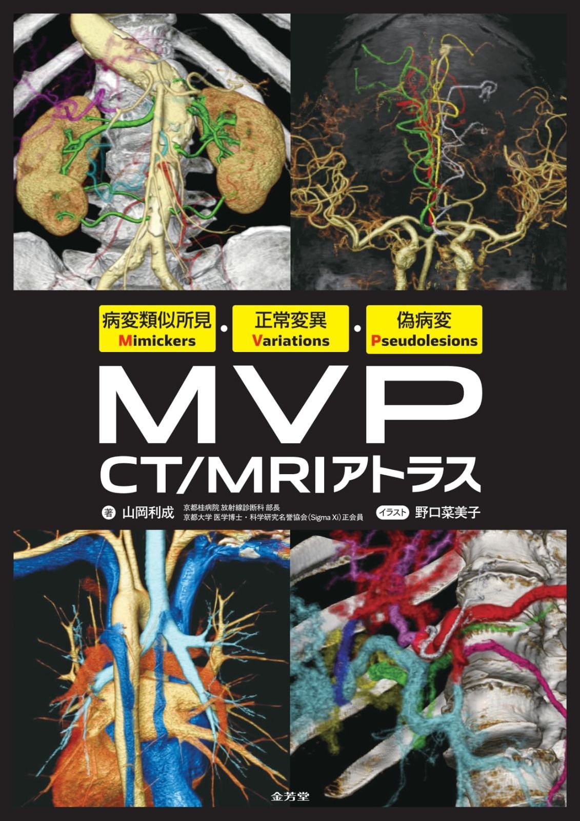病変類似所見Mimickers・正常変異Variations・偽病変Pseudolesions MVP