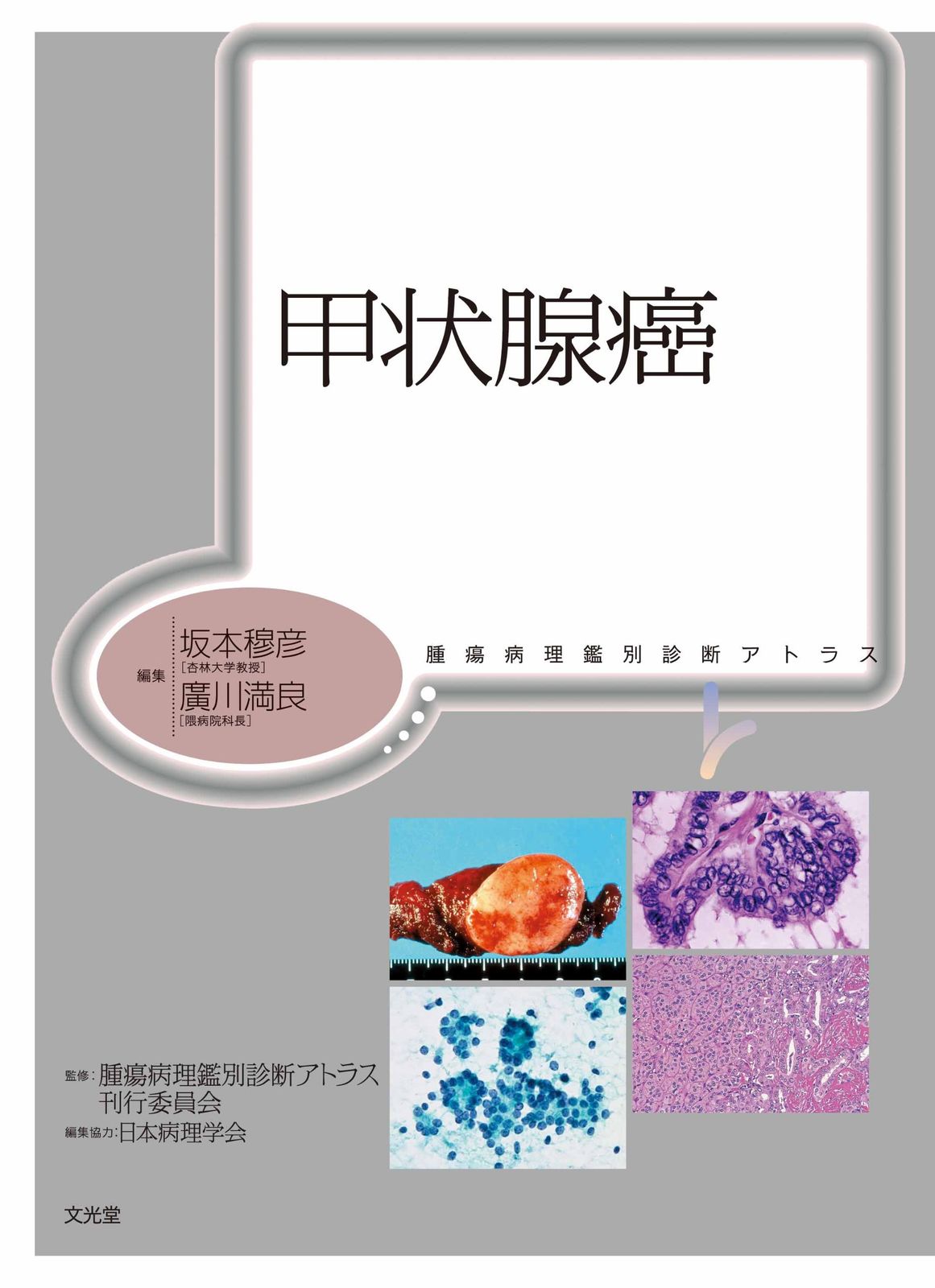 甲状腺癌 (腫瘍病理鑑別診断アトラス) 11,940円