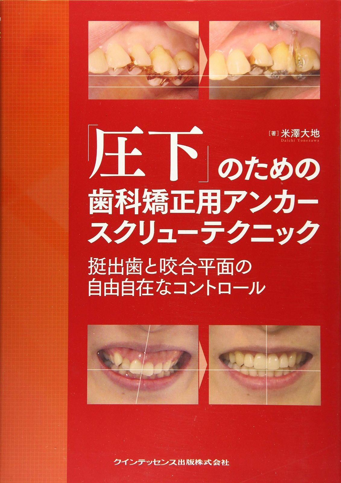 「圧下」のための歯科矯正用アンカースクリューテクニック 挺出歯と咬合平面の自由自在なコントロール