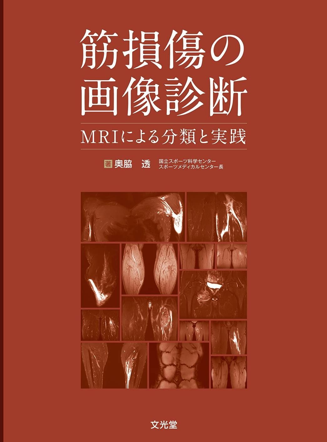 筋損傷の画像診断: MRIによる分類と実践