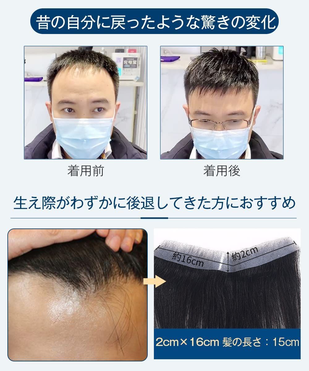 びまん性脱毛症 レデイーズ