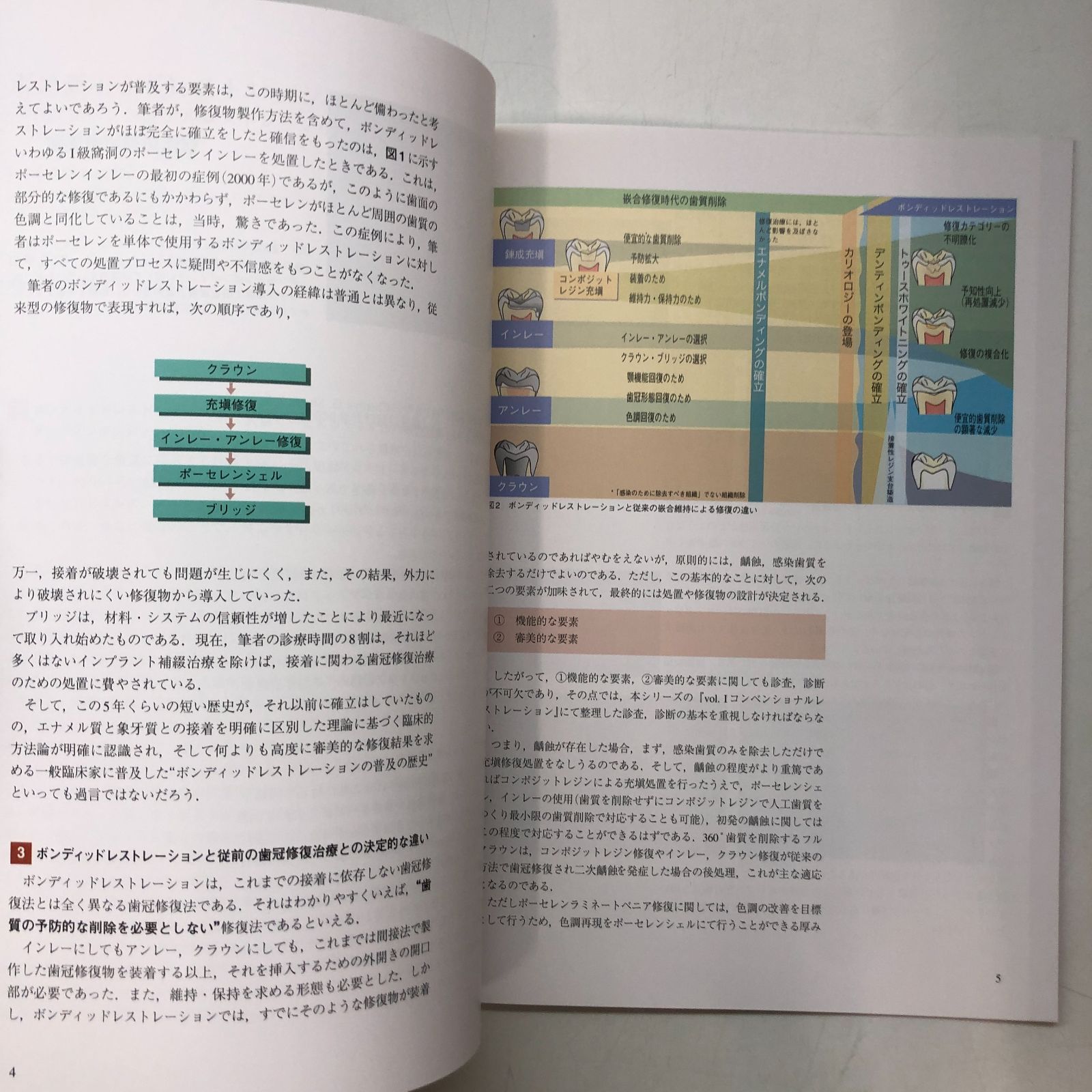 ボンディッドレストレーションとコンベンショナルレストレーション ボンディッドレストレーション (歯科臨床のエキスパートを目指して)