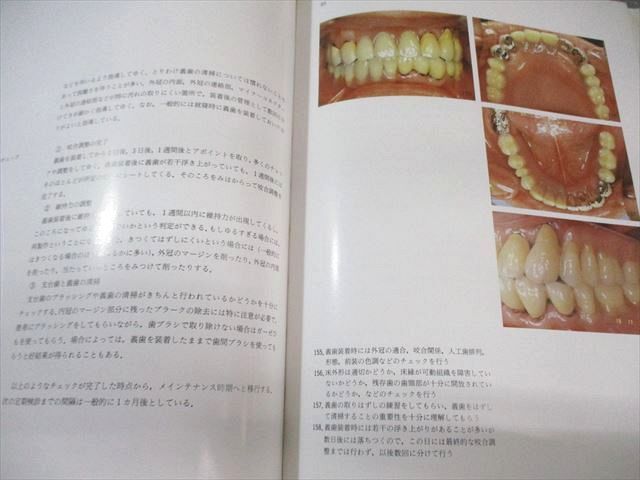 医歯薬出版 コーヌスクローネ 1988 黒田昌彦 025M3D Dental Graphic Series コーヌスクローネ/医歯薬出版株式会社