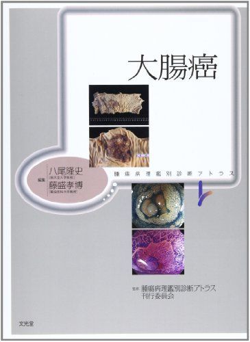 大腸癌 (腫瘍病理鑑別診断アトラス) 腫瘍病理鑑別診断アトラス 大腸癌 八尾 隆史 - メルカリ