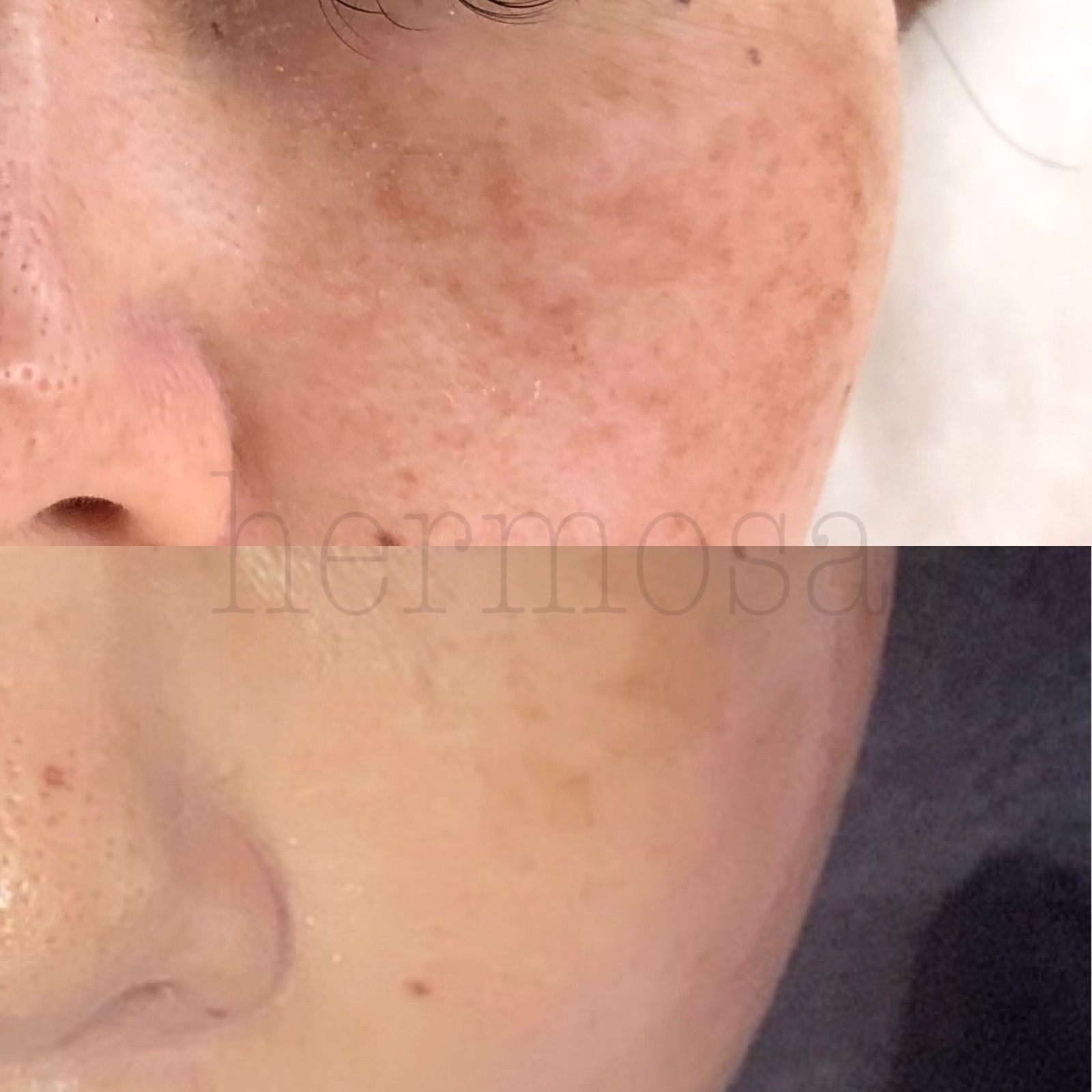 エルモサ スノーインテンシブスティック(シミ用美容液) ライト