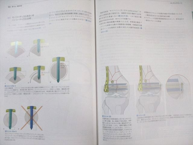 ☆裁断済 AO法骨折治療 第3版 医学書院 AO法 骨折治療 第3版 2020 055R3D - メルカリ