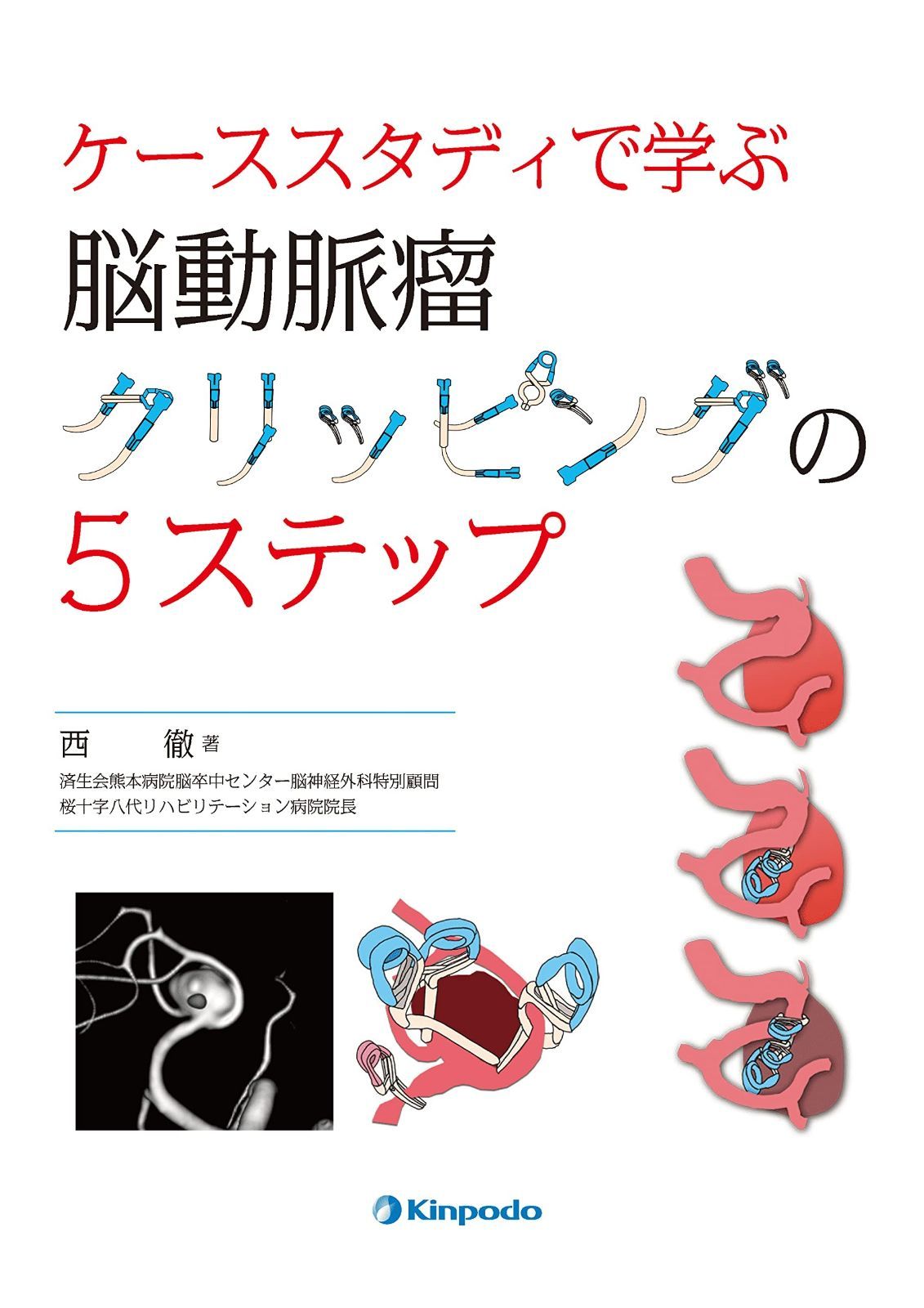人気，高品質 ケーススタディで学ぶ 脳動脈瘤クリッピングの5ステップ その他