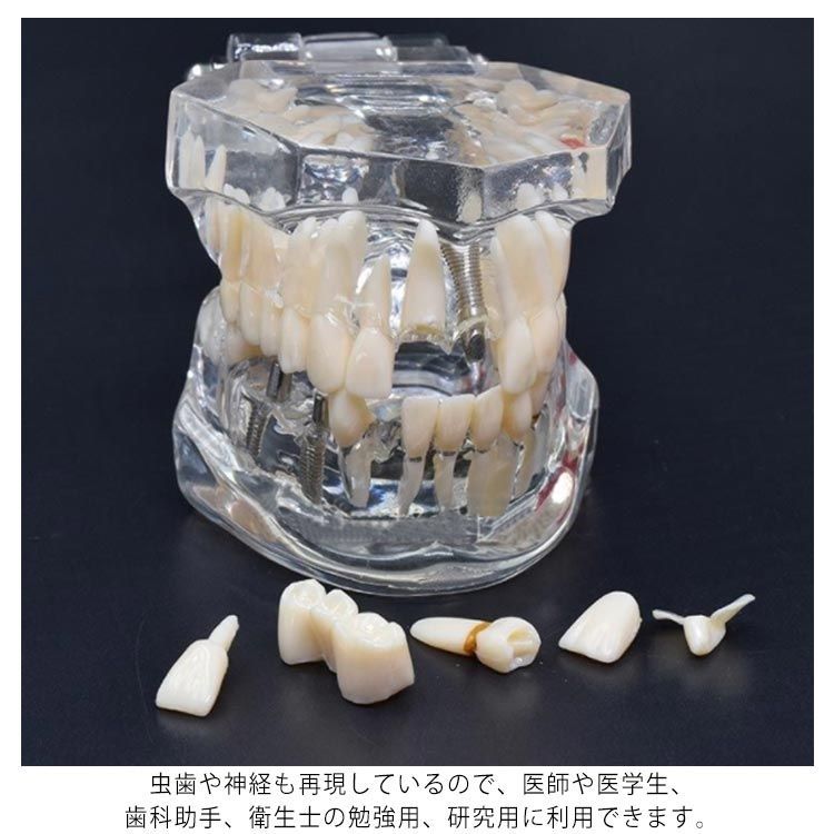 歯模型 透明 歯の模型 歯列模型 疾患展示模型 歯科模型 差し歯 歯医者