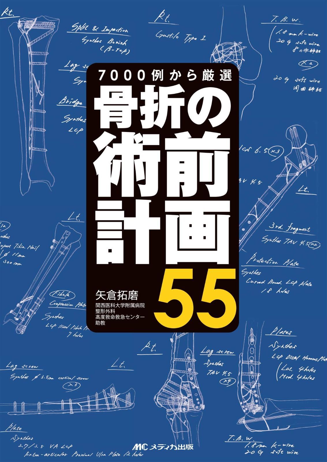 骨折の術前計画55: 7000例から厳選