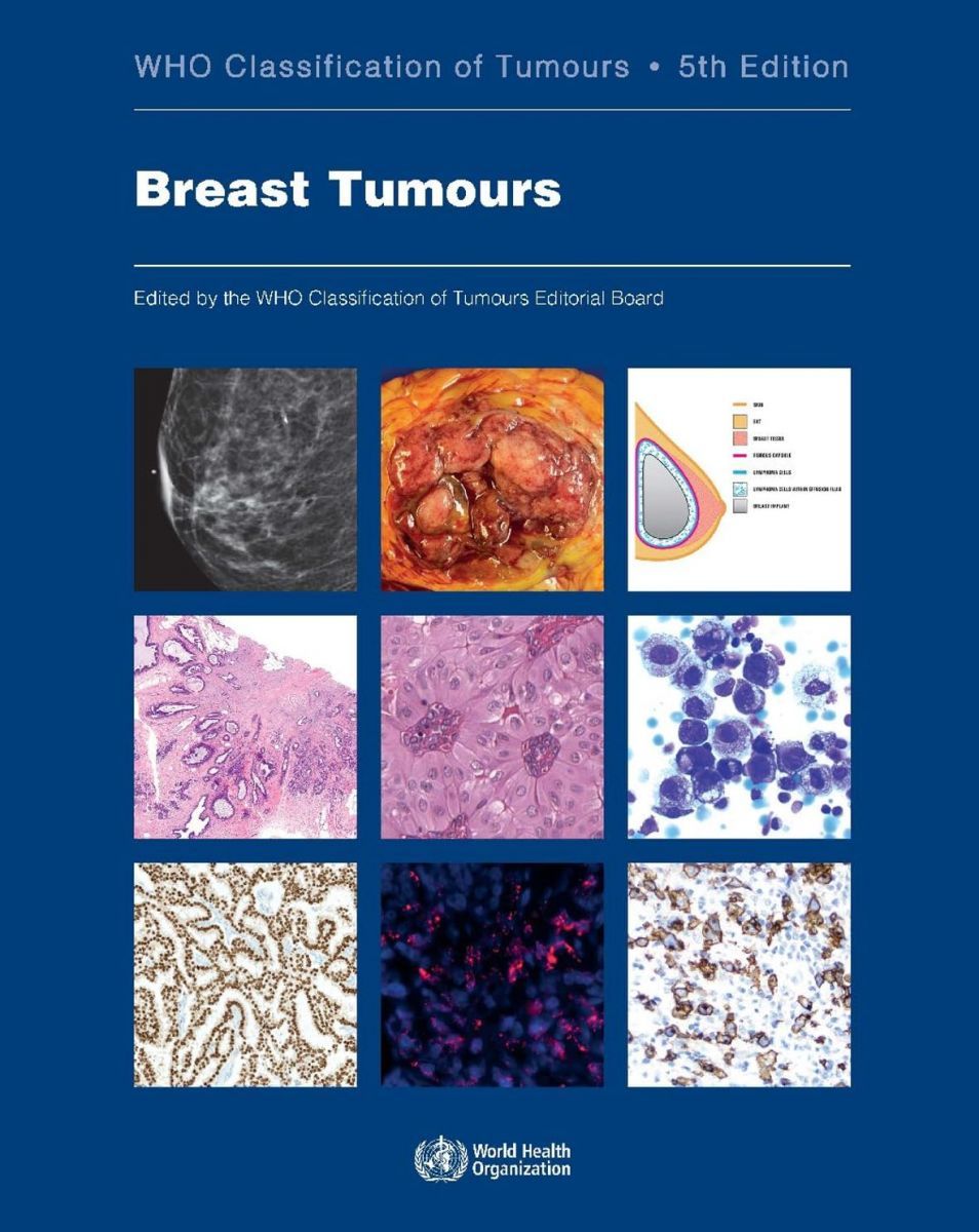 Breast Tumours (World Health Organization Classification of Tumours， 2)