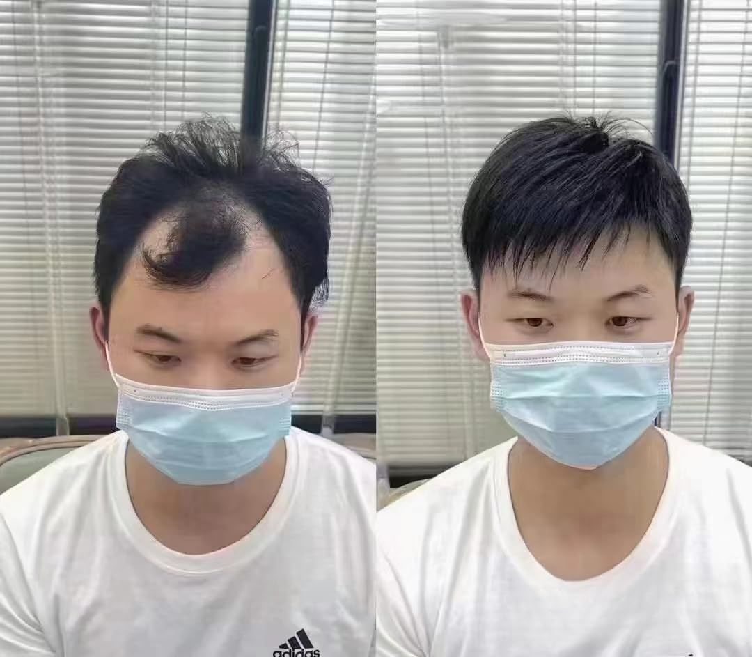 男性用 ヘアトップピース