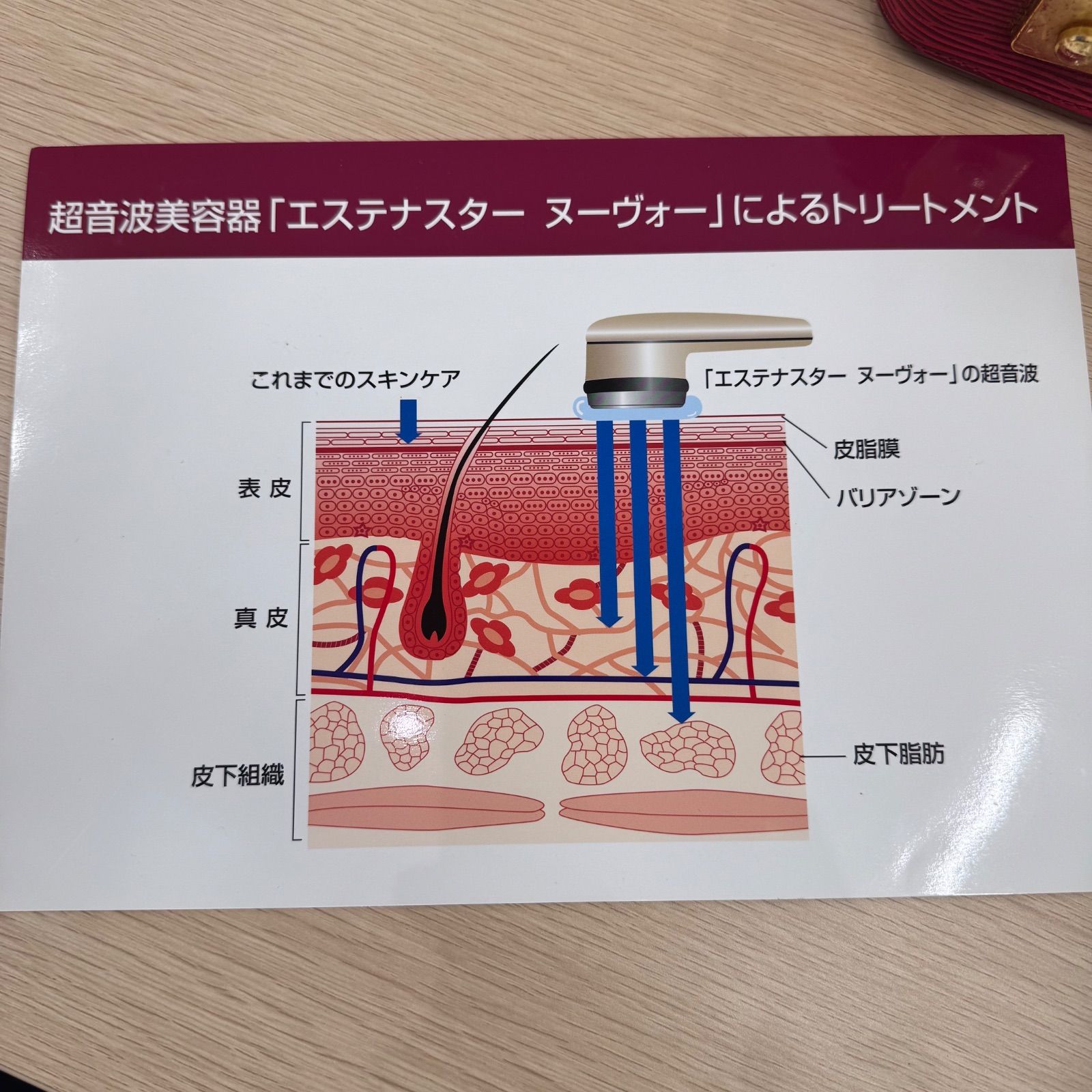 マイヤーMIYA 超音波美容器 エステナスターヌーヴォー - メルカリ
