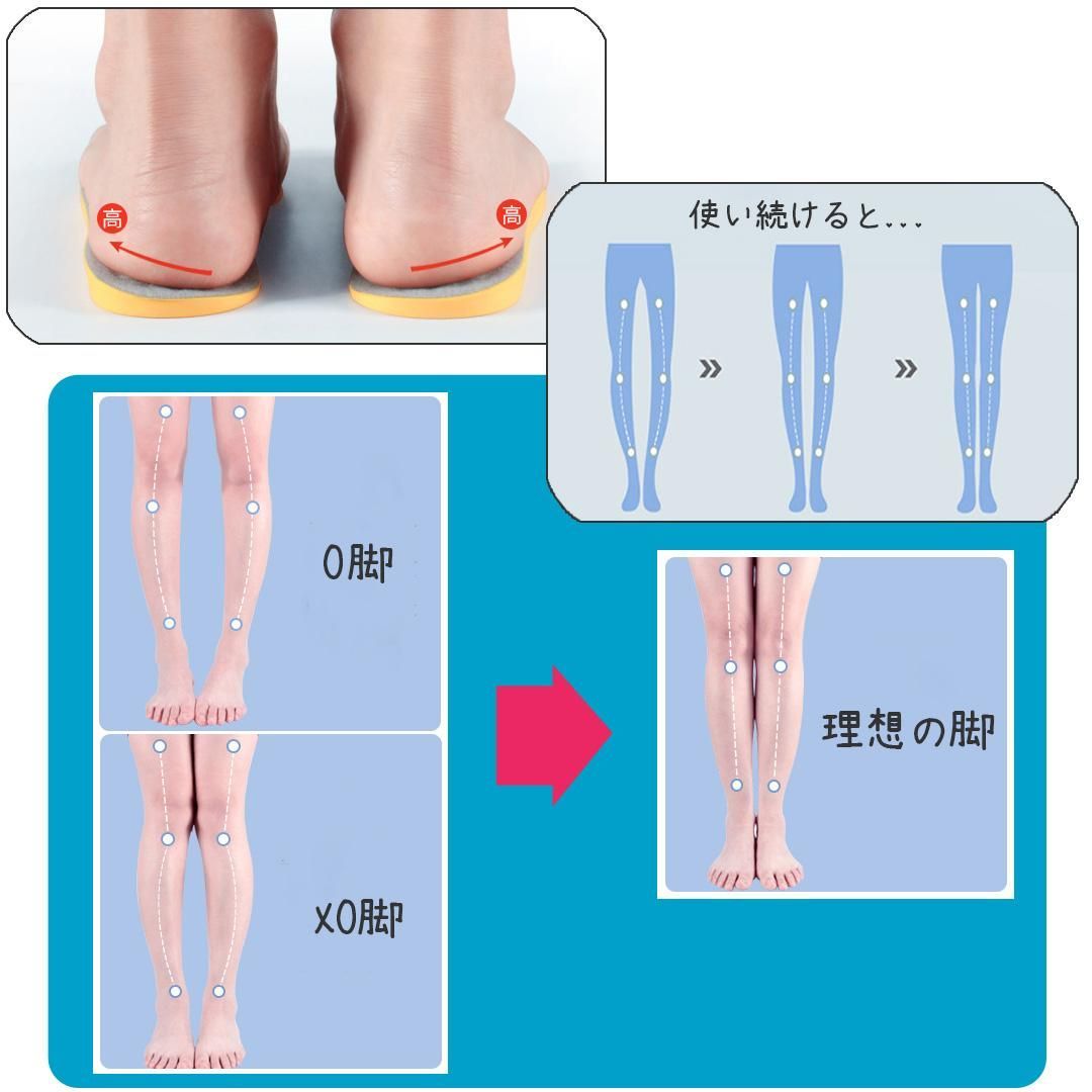 O脚矯正 美脚 インソール I脚 骨盤矯正 姿勢矯正 腰痛 扁平足