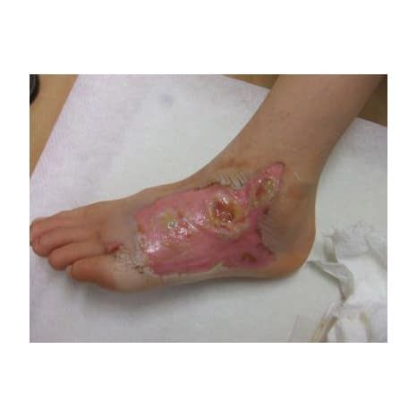 プラスモイストW 滅菌済 ドレッシング材 22-2049-00 プラスモイスト WA 1 A 10マイ