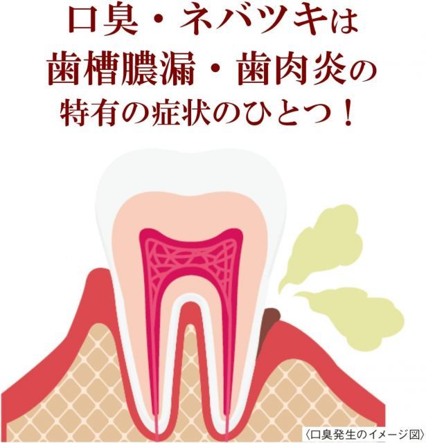 歯肉炎 ハグキのハレ