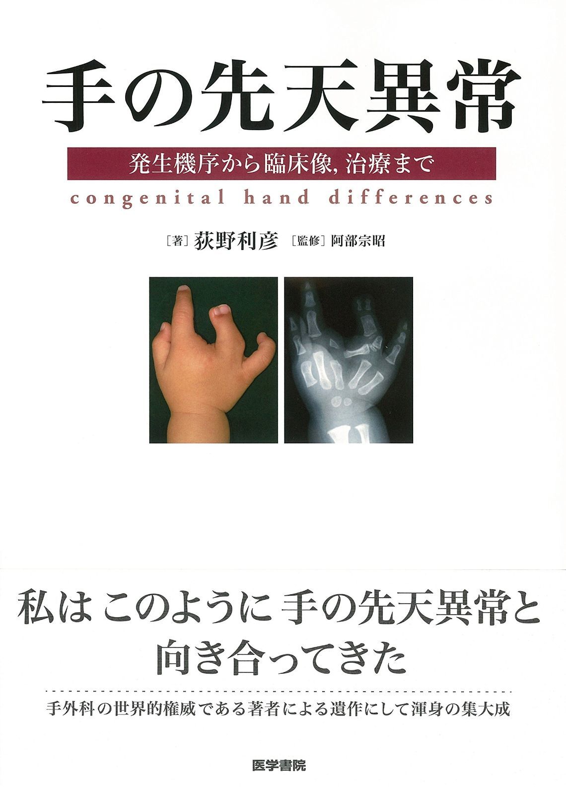 手の先天異常 発生機序から臨床像 ｶﾝﾏ 治療まで