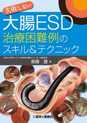 【中古】失敗しない大腸ESD治療困難例のスキルu0026テクニック
