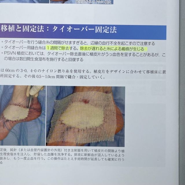 裁断済】形成外科治療手技全書Ⅱ 形成外科の基本手技２ - メルカリ