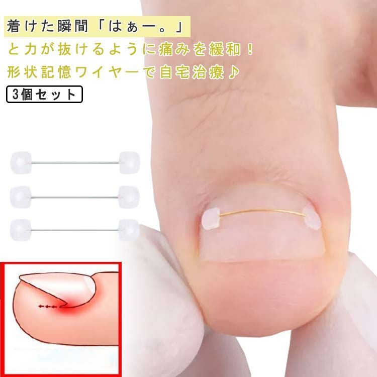 お得な3点セット♪巻き爪矯正器具2個とワイヤースプリングセット！