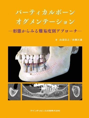 【人気定番，SALE】 バーティカルボーンオグメンテーション その他