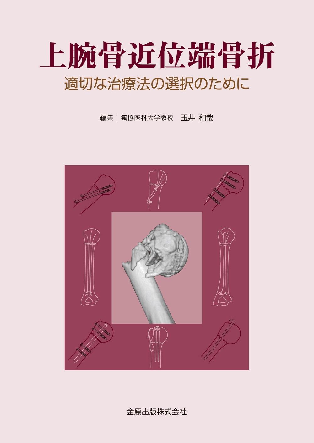 上腕骨近位端骨折―適切な治療法の選択のために―