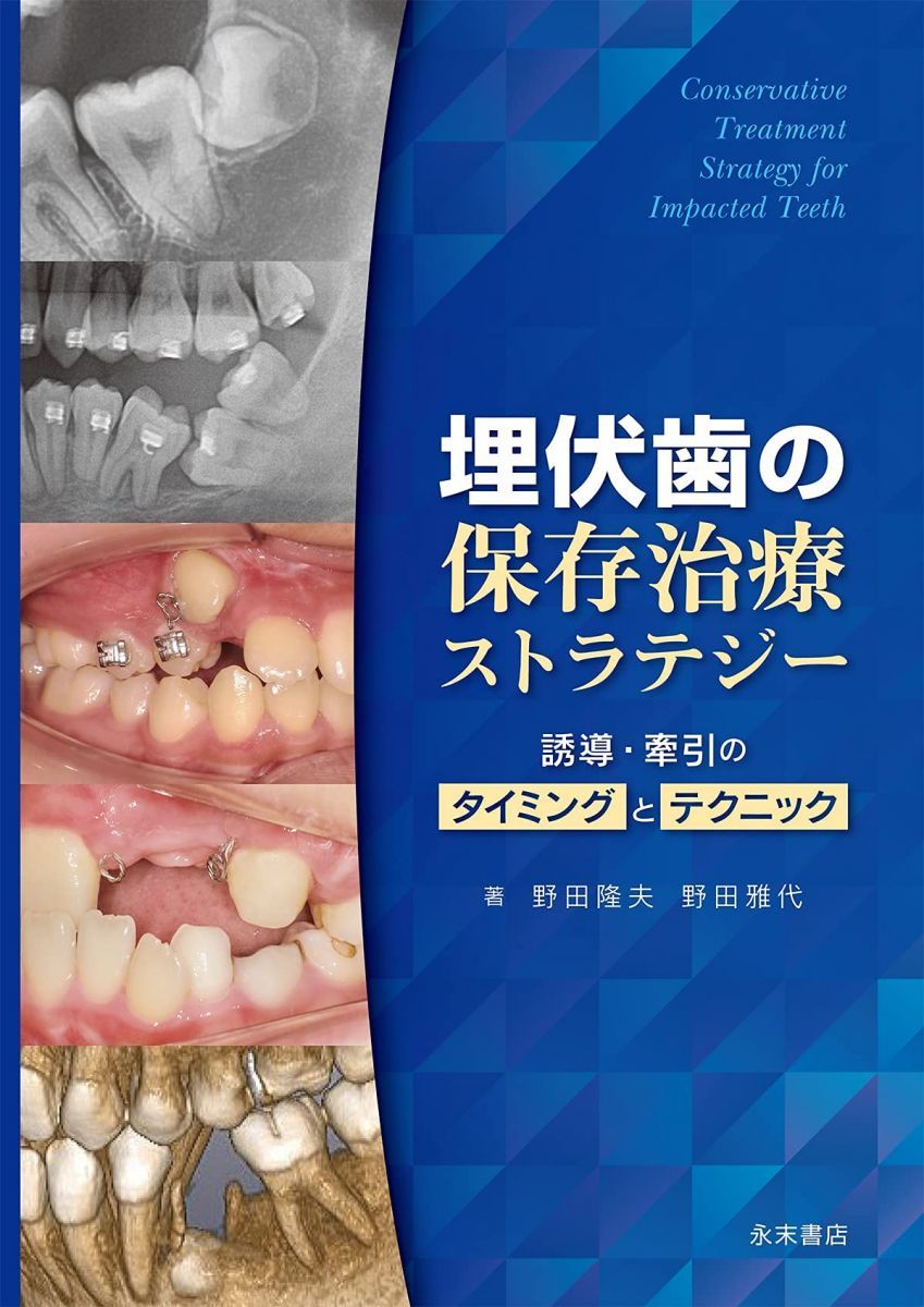 埋伏歯の保存治療ストラテジー 誘導・牽引のタイミングとテクニック