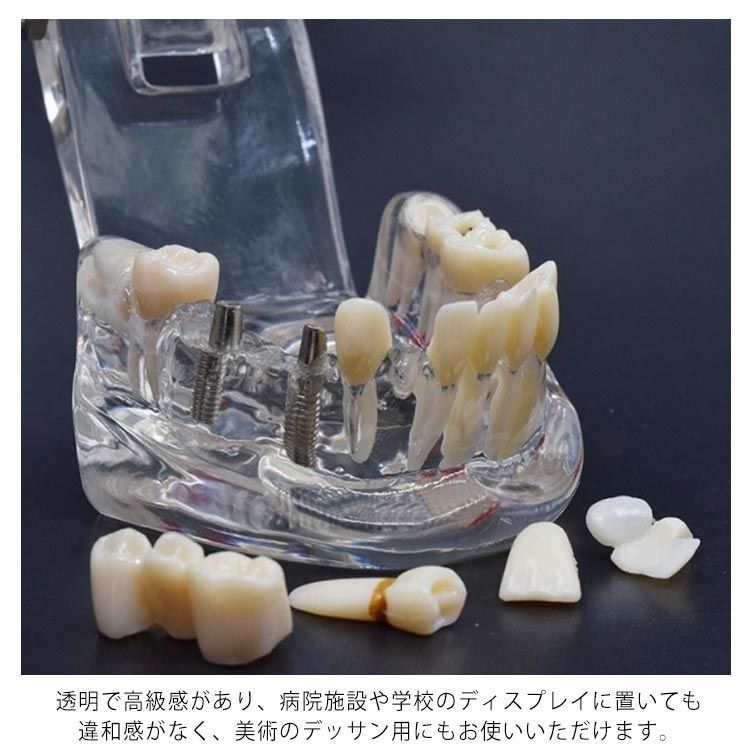 透明歯牙疾患模型 FEEDデンタル】成人 疾患説明用透明顎模型の通販｜カリエス・ペリオ