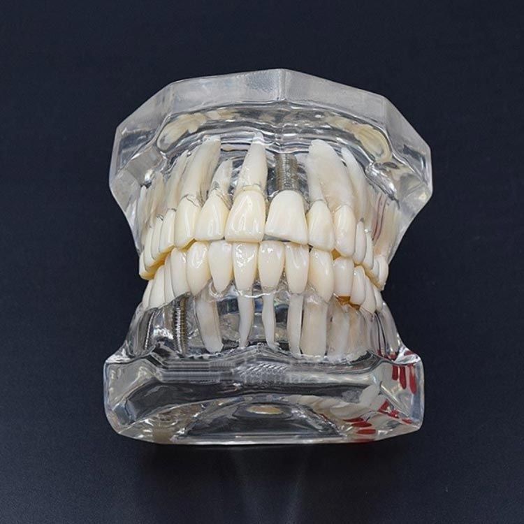 透明歯牙疾患模型 透明歯牙疾患模型