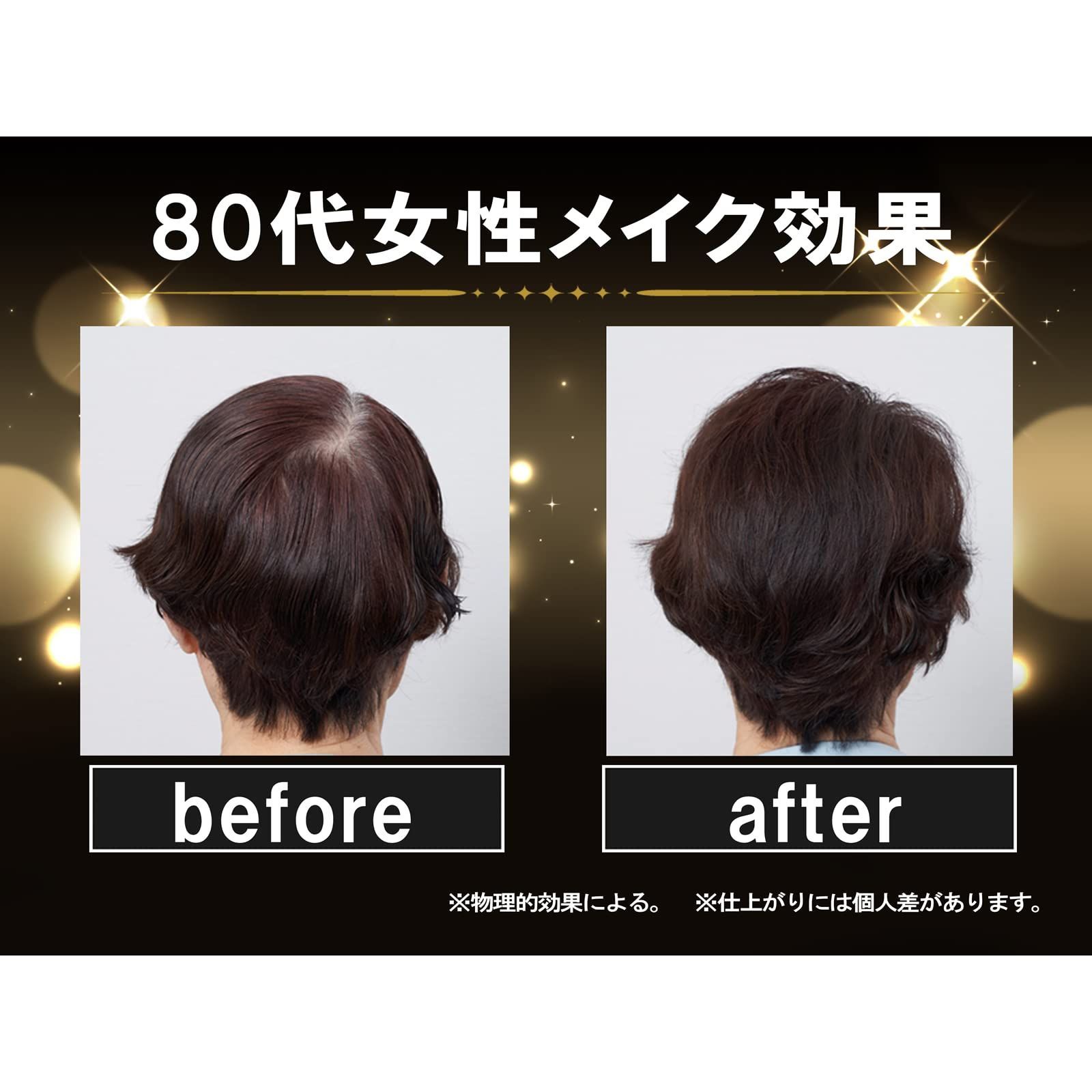 円形脱毛症 生え際