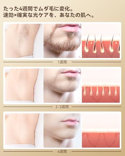 IPL光脱毛器 メンズ