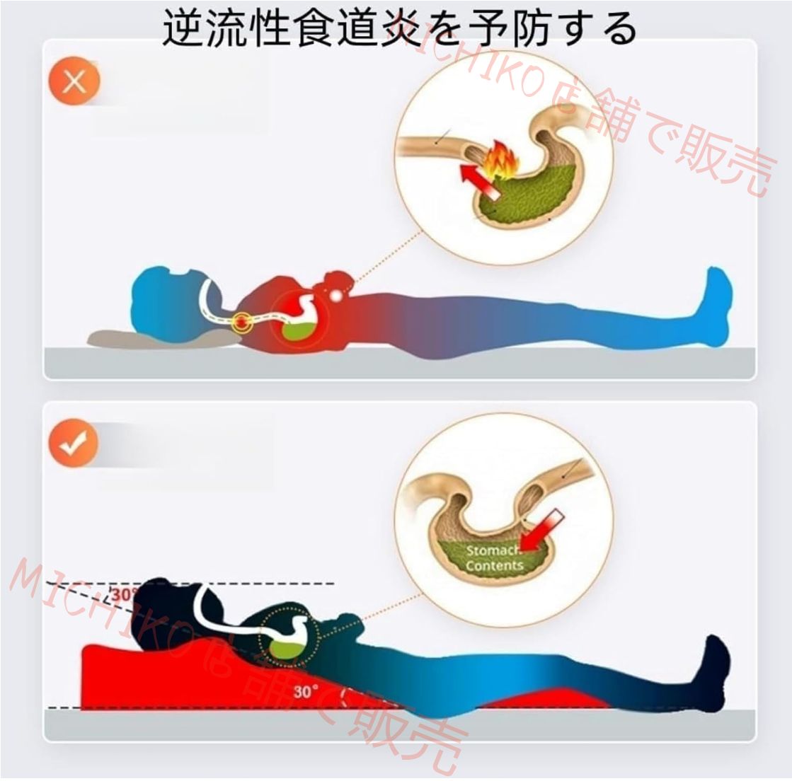 良性発作性頭位めまい症 逆流性食道炎