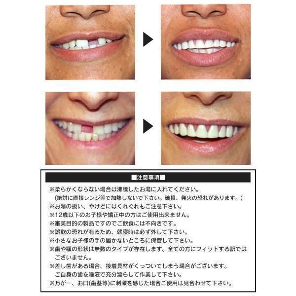 付け歯 前歯