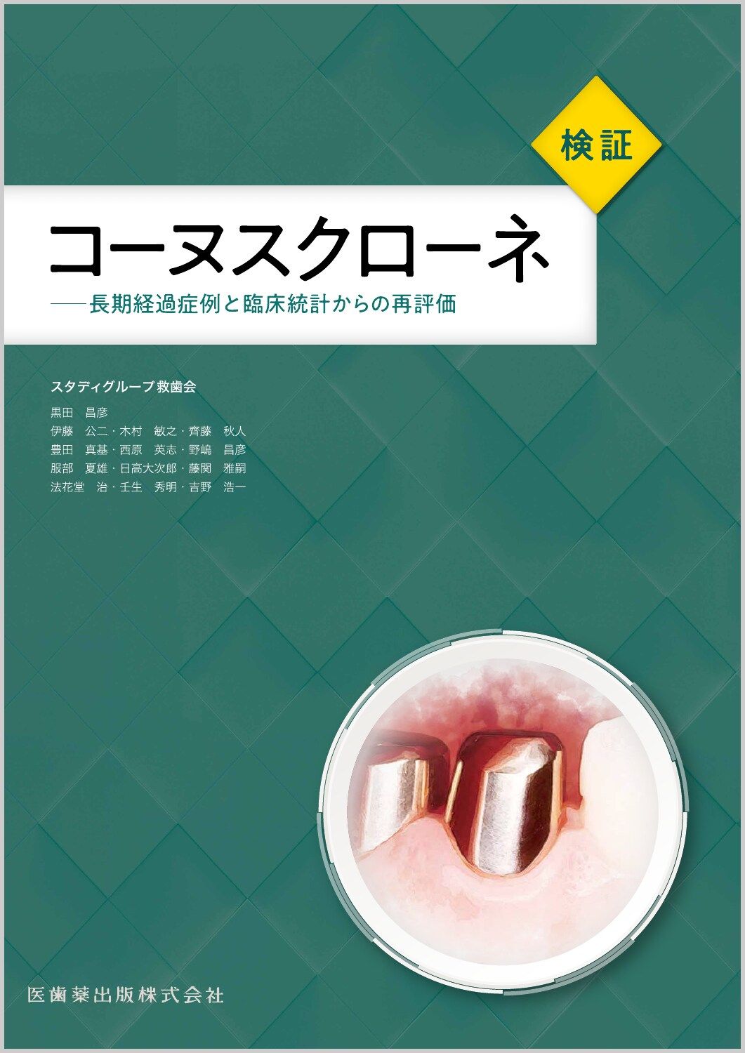 検証コーヌスクローネ 長期経過症例と臨床統計からの再評価|医歯薬出版|スタディグループ救歯会 大型本