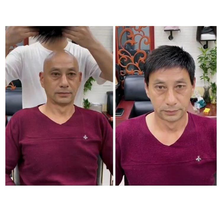 円型脱毛症