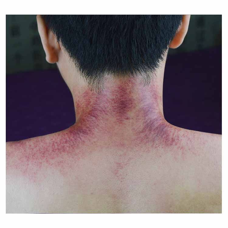 マッサージ スクレイピング