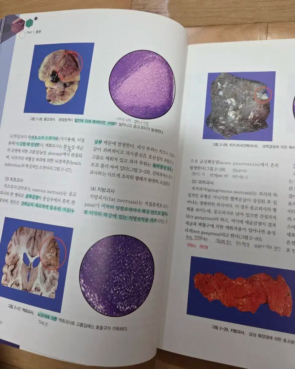 核心 病理学 ウンバクサ ー ドロマイト