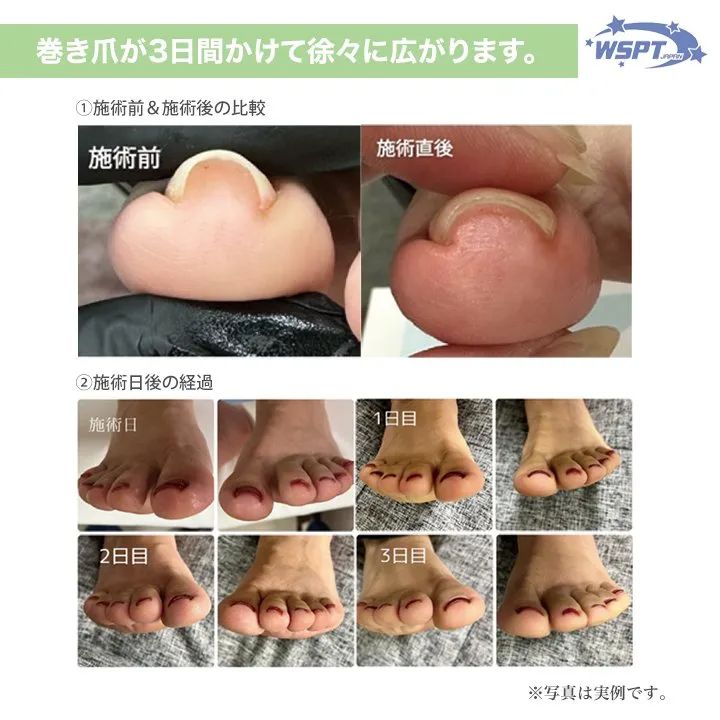 巻き爪ケア フラットケアジェル 3本セット