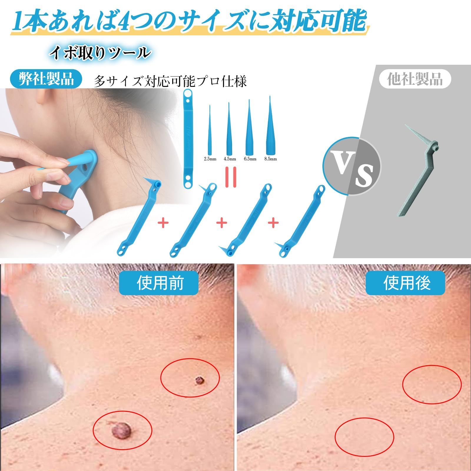 数量限定】イほ''除去 スギンタクリムーバーツール イボ取り １本で４サイズのゴム輪 2.5mm 4.5mm セルフ処理ツール 6.5mm 8.5mm  メルカリ