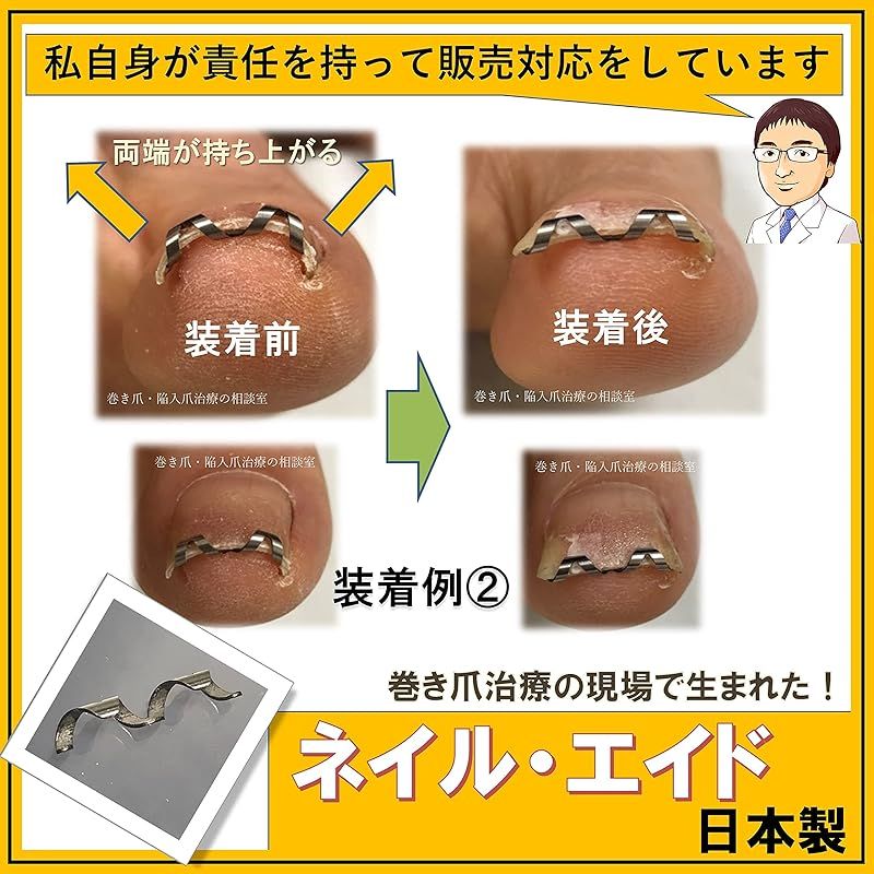 ネイルエイド 16 巻き爪 矯正 自分で 巻きづめ ワイヤー クリップ - 限定50％オフ